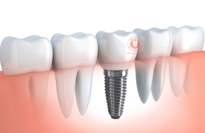 Trồng răng implant