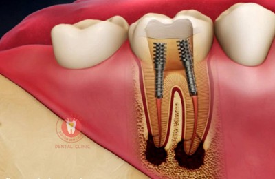 ĐIỀU TRỊ TỦY RĂNG AN TOÀN BẰNG CÔNG NGHỆ TÂN TIẾN TẠI NHA KHOA SÀI GÒN KIM CƯƠNG