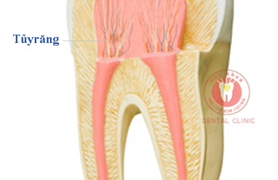 Nguyên nhân viêm tủy răng và cách chữa tủy răng tại Nha Khoa Sài Gòn Kim Cương