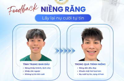 Niềng răng mất bao lâu để có kết quả như ý? 