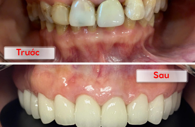 Chi phí bọc răng sứ tại Bệnh viện Răng Hàm Mặt Sài Gòn Kim Cương